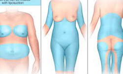 Liposuction Method