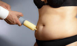 Liposuction: Sağlıklı Bir Yöntem Olabilir Ancak Bu Faktörlere Dikkat Etmek Gerekir! 