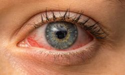 Uganda'da Kırmızı Göz Hastalığı Salgını: 7,500 Vaka Bildirildi!