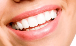 Hollywood Smile nedir ve kimlere uygundur?