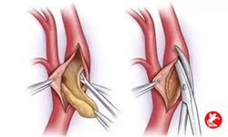 Sırrı Süreyya Önder’in de Yaşadığı Aort Yırtılması Nedir?