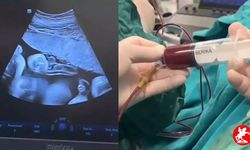8 Aylık Bebeğe Anne Karnında Kan Nakli! Doktorlar Hayrete Düşüren Müdahaleyi Başarıyla Gerçekleştirdi