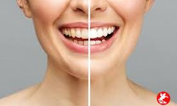Diş Sararması Neden Olur? Nasıl Geçer?