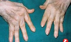 Romatoloji Nedir? Eklem ve Kas Sağlığının Bilinmeyen Yüzü