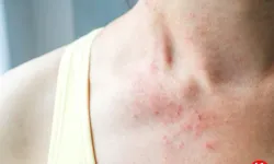 Nörofibromatozis: Genetik Bir Hastalığın Görünmeyen Yüzü