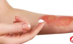 Cilt Kanseri Riskini Azaltmak İçin Bunlara Dikkat Edin: Uzmanlardan Kritik Uyarılar!