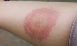 Lyme Hastalığı: Sinsi Tehlike Her An Kapınızı Çalabilir! Bu Belirtileri Göz Ardı Etmeyin