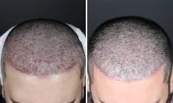 Samsun Saç Ekimi Fiyatları