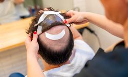 Samsun Protez Saç Fiyatları 2026