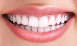 Samsun Diş Beyazlatma Fiyatları 2026