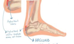 Haglund Deformitesi: Topukta Kemik Çıkıntısı Neden Olur, Nasıl Geçer?