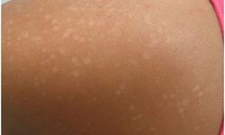 Beyaz Güneş Lekesi Neden Olur?