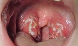 Boğaz Enfeksiyonları ile Strep Boğazı Arasındaki Farklar Neler? Uzmanlar Uyarıyor