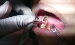 Samsun’da Acil Diş Çekimi İçin En Yakın Poliklinik Nerede?