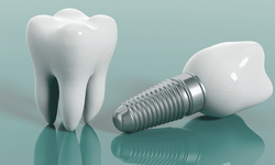 Samsun İmplant Fiyatları 2026: Tedavi Süreçleri Hakkında Detaylı Bilgiler