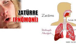 Zatürre Belirtileri ve Korunma Yolları: Sessiz Tehlikeye Karşı Bilmeniz Gerekenler