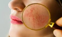 Lupus Nedir, Nasıl Anlaşılır?