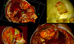 Görünmezi Görünür Kılmak: Beyin ve Omurga Cerrahisinde Dijital Segmentasyon