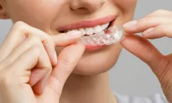 Yetişkinlerde Diş Çapraşıklığı Tedavisi: Teller Olmadan Mümkün Mü?