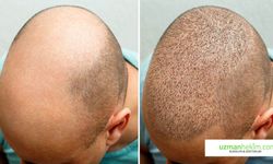 Saç Ekim İçin Dünyanın Dört Bir Tarafından İstanbul’a Geliyorlar !!