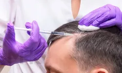 SAÇ EKİMİNİN HÜSRANLA SONUÇLANMAMASI İÇİN DİKKAT ETMENİZ GEREKEN 10 ŞEY