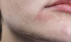 Cilt Kuruluğu Nasıl Giderilir? Uzmanlardan Günlük Hayatta Uygulanabilecek Etkili Öneriler