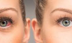 Göz Kuruluğu Neden Olur? Günlük Hayatı Zorlaştıran Bu Sorun Neden Artıyor?