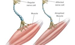ALS Hastalığı Nedir? ALS Hastalığının Nedenleri Nelerdir?