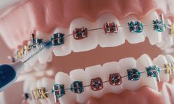 2026 Yılında Diş Teli Tedavisi: Süreç, Seçenekler ve Merak Edilenler
