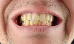 Dişlerimiz Sararmışsa Evde Yapabileceğimiz 3 İşlem