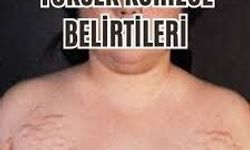 Kortizol Hormonu Nedir? Yüksekliği Vücutta Nasıl Belirti Verir?