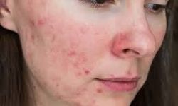 Ciltte Ani Sivilce Artışı Neden Olur? Hangi Hastalıklarla İlişkili?