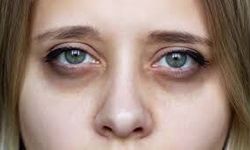 Göz Altı Morlukları Neden Oluşur? Kalıcı Çözüm Yöntemleri Nelerdir