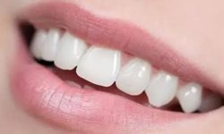 Sarı Dişleri Evde Beyazlatmanın 3 Yöntemi