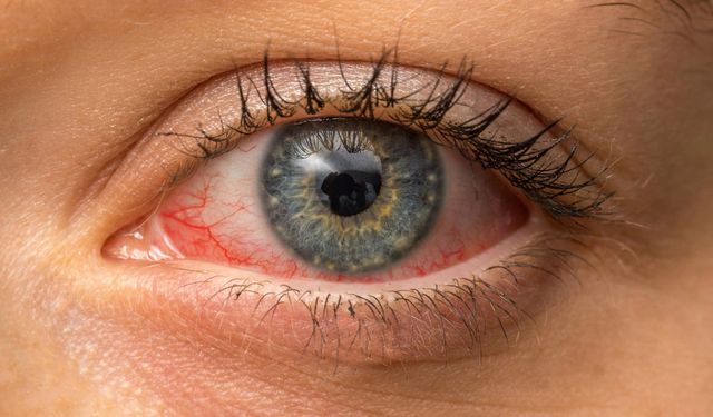 Uganda'da Kırmızı Göz Hastalığı Salgını: 7,500 Vaka Bildirildi!