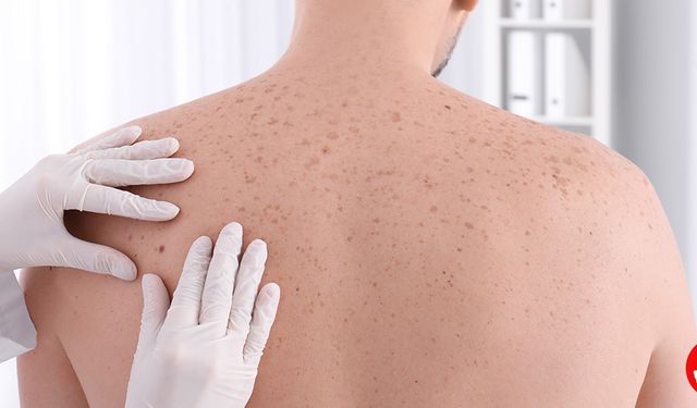 37 İlde Ücretsiz Deri Taraması Başladı! Erken Tanıyla Hayat Kurtarılabilir