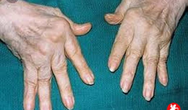 Romatoloji Nedir? Eklem ve Kas Sağlığının Bilinmeyen Yüzü
