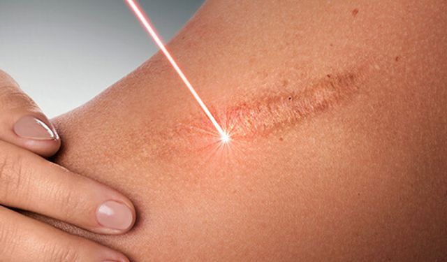 Kalıcı Yara İzlerine Son! Avustralyalı Bilim İnsanları'ndan Devrim Niteliğinde Tedavi