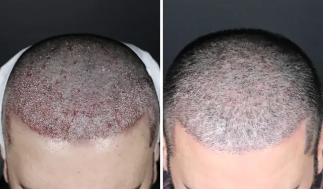 Samsun Saç Ekimi Fiyatları 2026