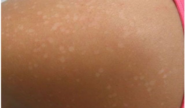 Beyaz Güneş Lekesi Neden Olur?