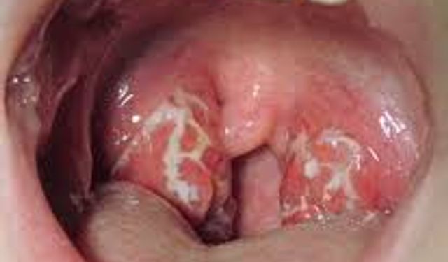 Boğaz Enfeksiyonları ile Strep Boğazı Arasındaki Farklar Neler? Uzmanlar Uyarıyor