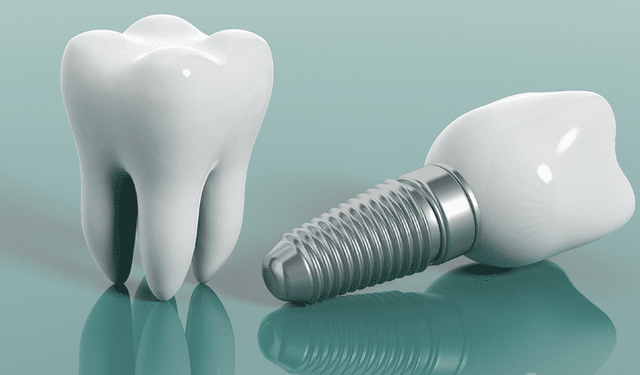 Samsun İmplant Fiyatları 2026: Tedavi Süreçleri Hakkında Detaylı Bilgiler