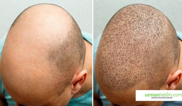 Saç Ekim İçin Dünyanın Dört Bir Tarafından İstanbul’a Geliyorlar !!