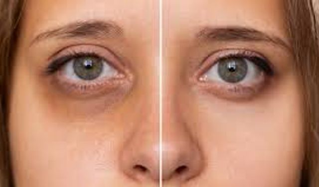 Göz Altı Morluklarına Ne İyi Gelir? Uzmanlardan Etkili Öneriler