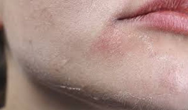 Cilt Kuruluğu Nasıl Giderilir? Uzmanlardan Günlük Hayatta Uygulanabilecek Etkili Öneriler