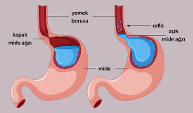 Reflü Nedir, Neden Olur? Günlük Hayatı Zorlaştıran Bu Sorun Hakkında Merak Edilenler