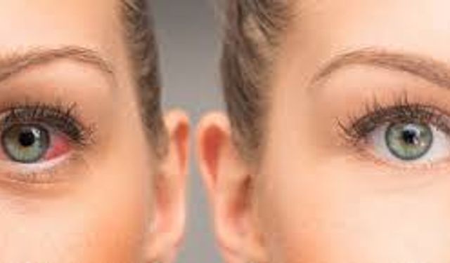 Göz Kuruluğu Neden Olur? Günlük Hayatı Zorlaştıran Bu Sorun Neden Artıyor?