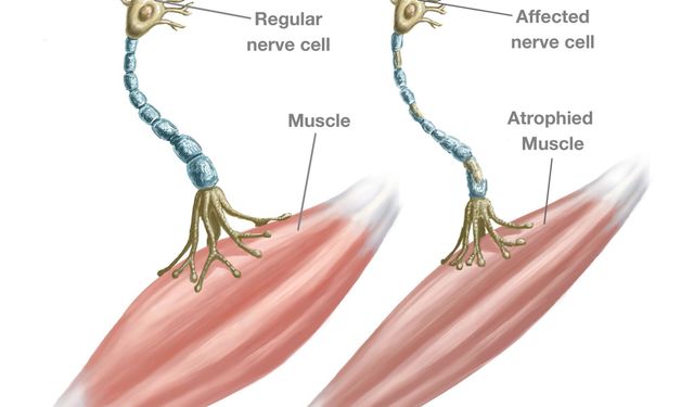 ALS Hastalığı Nedir? ALS Hastalığının Nedenleri Nelerdir?