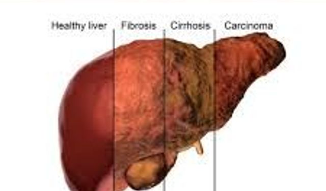 Karaciğer Yağlanması Nedir? Belirtileri ve Doğal Tedavi Yöntemleri