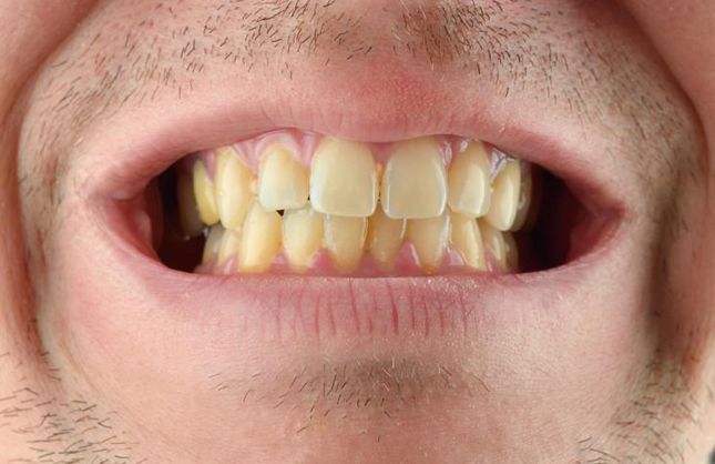Dişlerimiz Sararmışsa Evde Yapabileceğimiz 3 İşlem